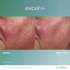 Excel V+ Cool View + Dermastat by Cutera