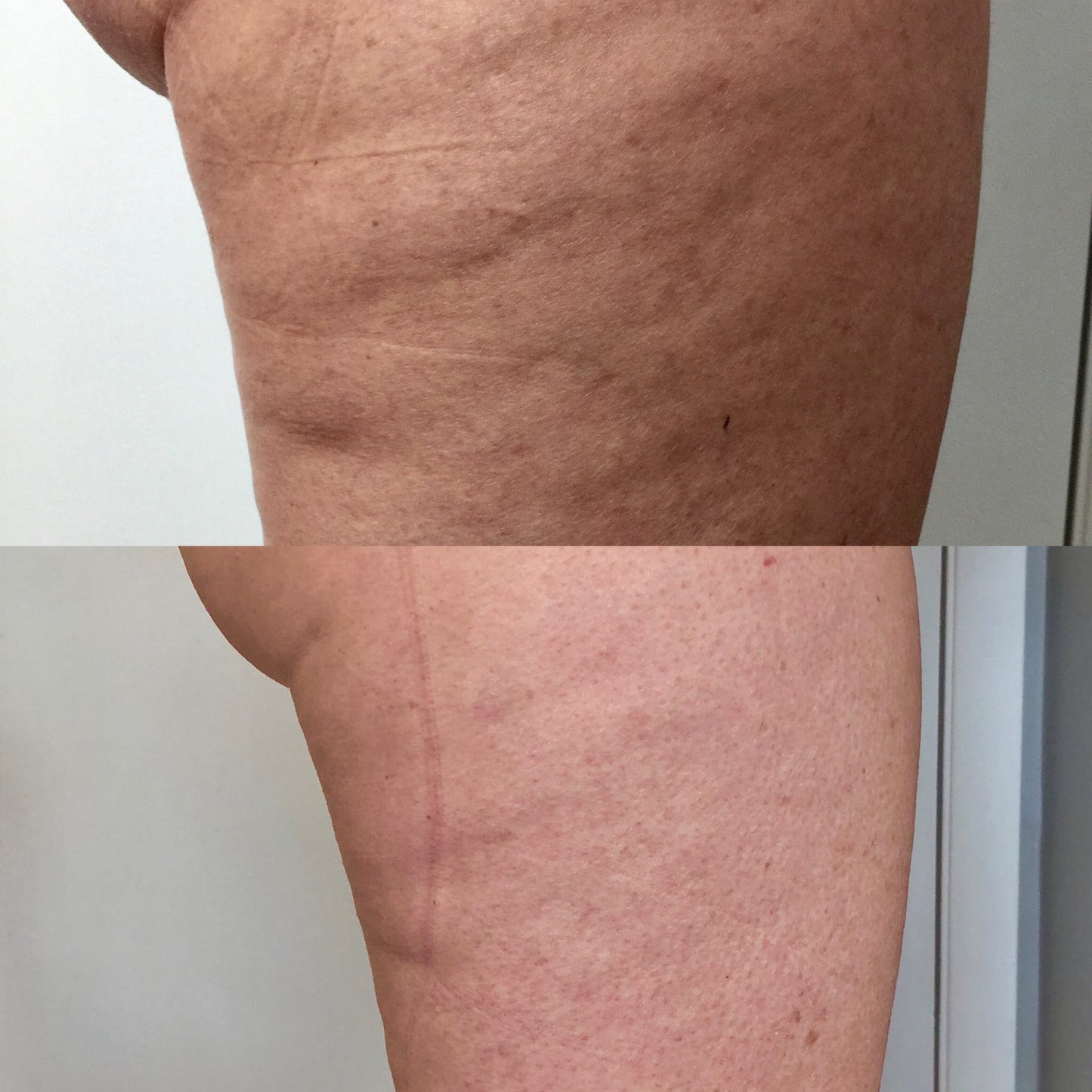 Non Invasive Body Contouring with Evolve, BodyFX & Forma Plus