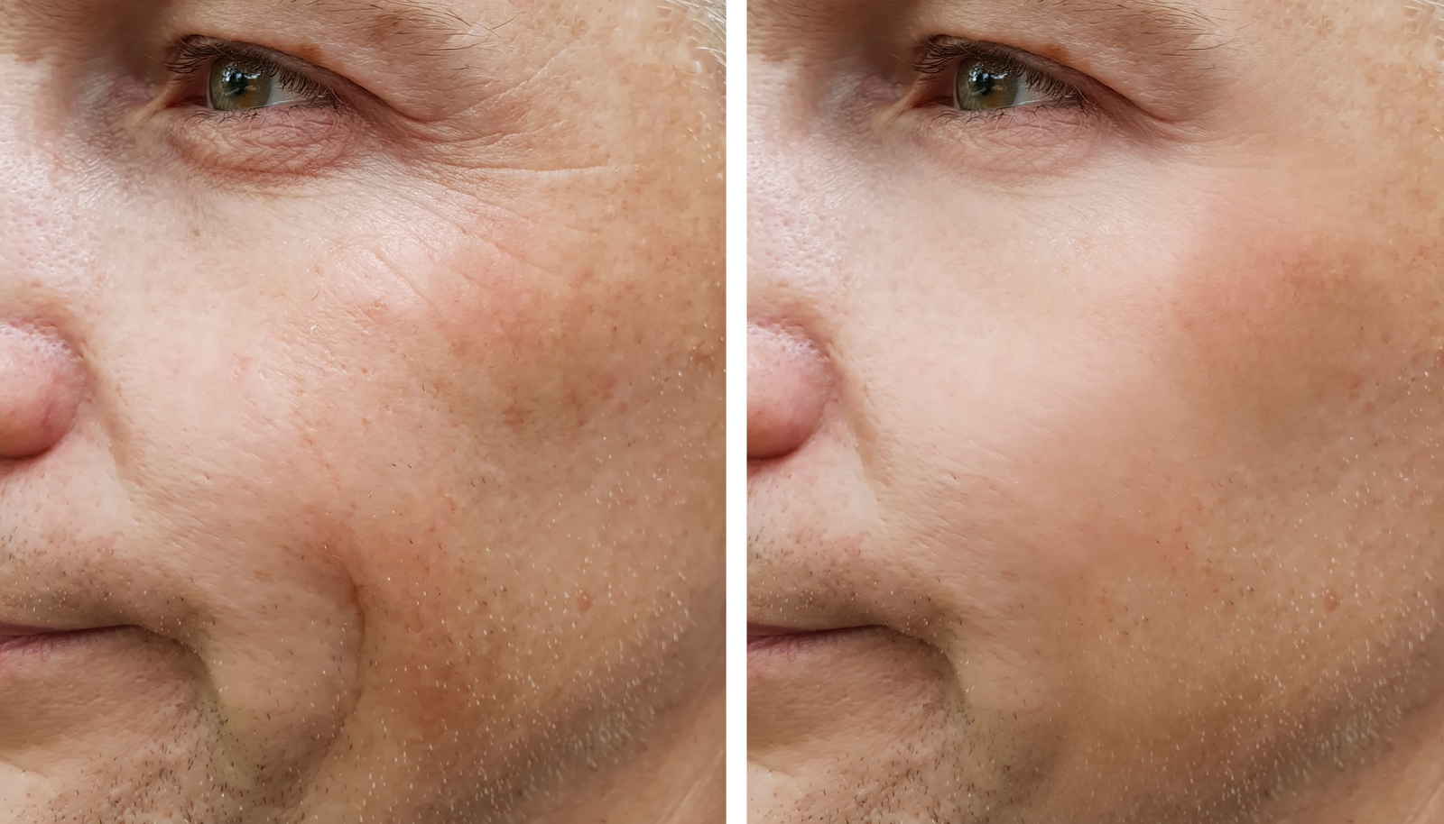 Before and after results