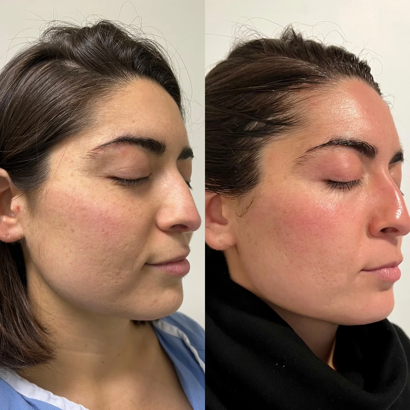 Before and after results